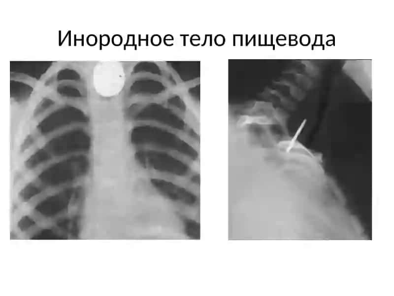 Лучевая диагностика заболеваний желудочно кишечного тракта 4