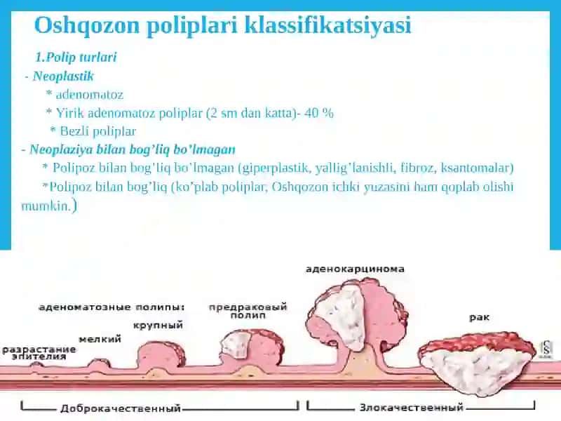 Oshqozon polipozi 4