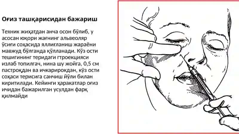 Стоматологиядаги огрик,сизлантиришлар: инфраорбитал, инцизивал, платинал 4