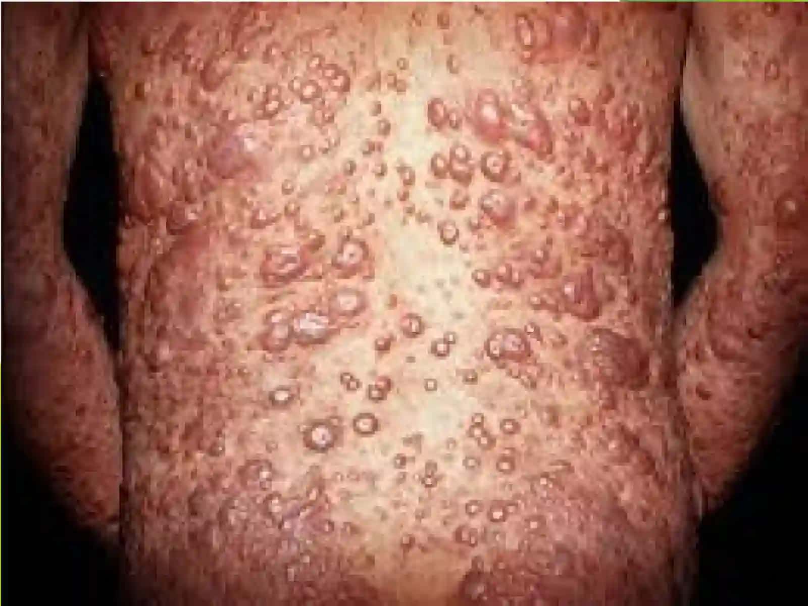 Moxoвkaсалигиқўзгатувчиси(Mycоbacterium leprae Hansen) 4
