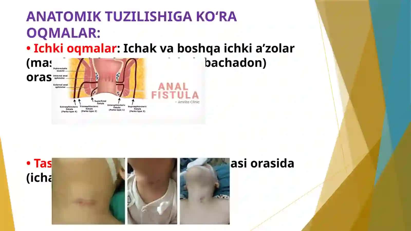ICHAK OQMA YARALARINIBARTARAF QILISH USULLARI 4