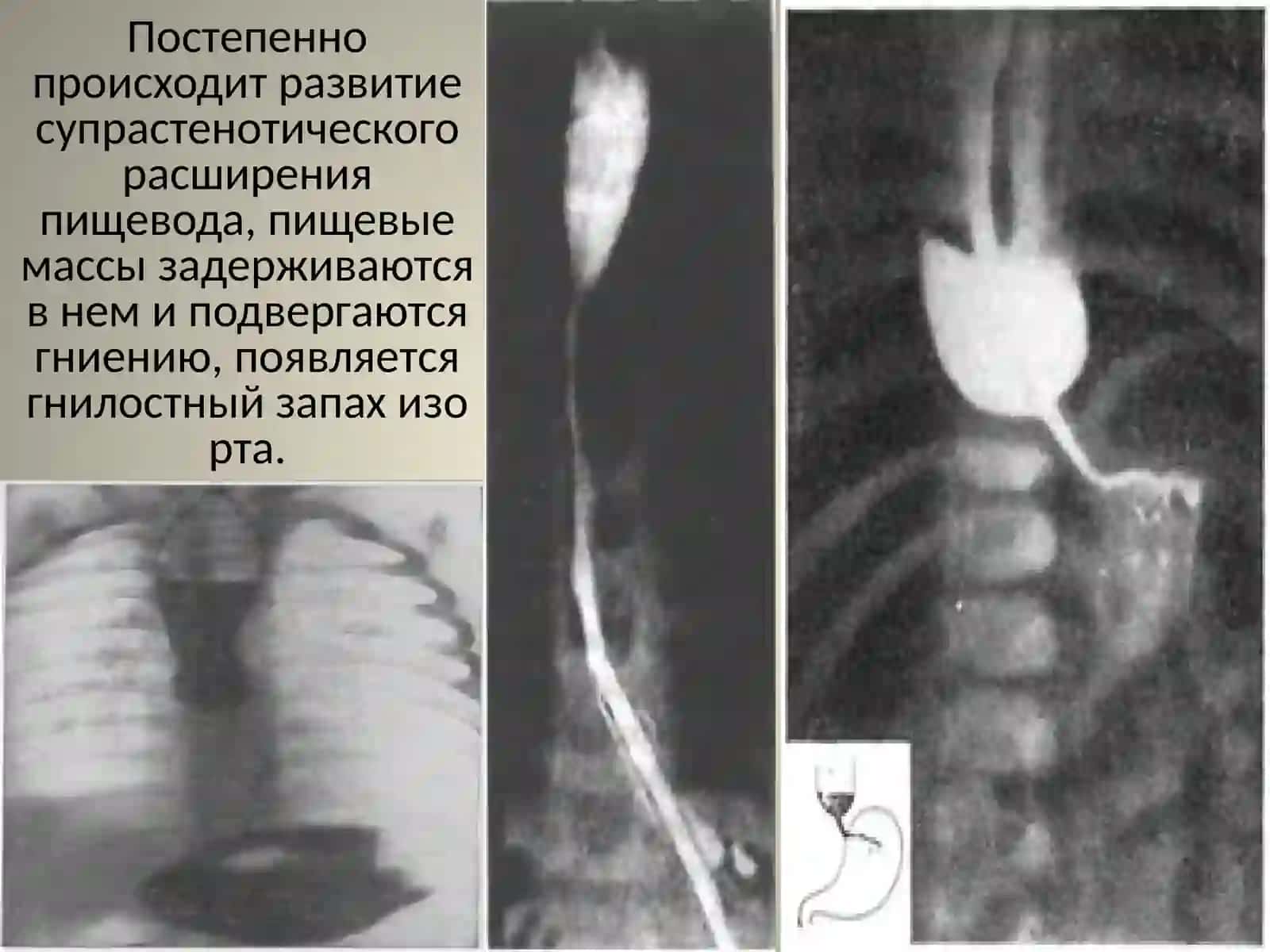 Аномалии развития пищевода 4