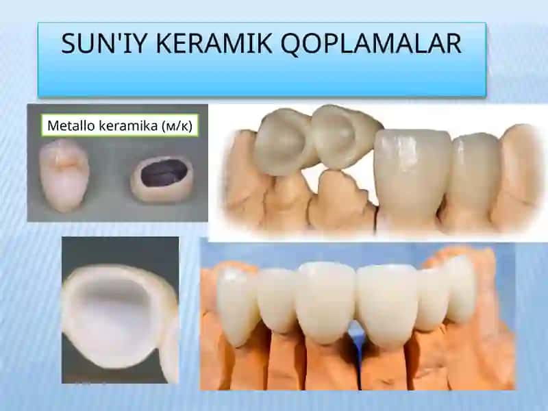 Sirkoniydioksid, stomatologik, keramika, farfor 4