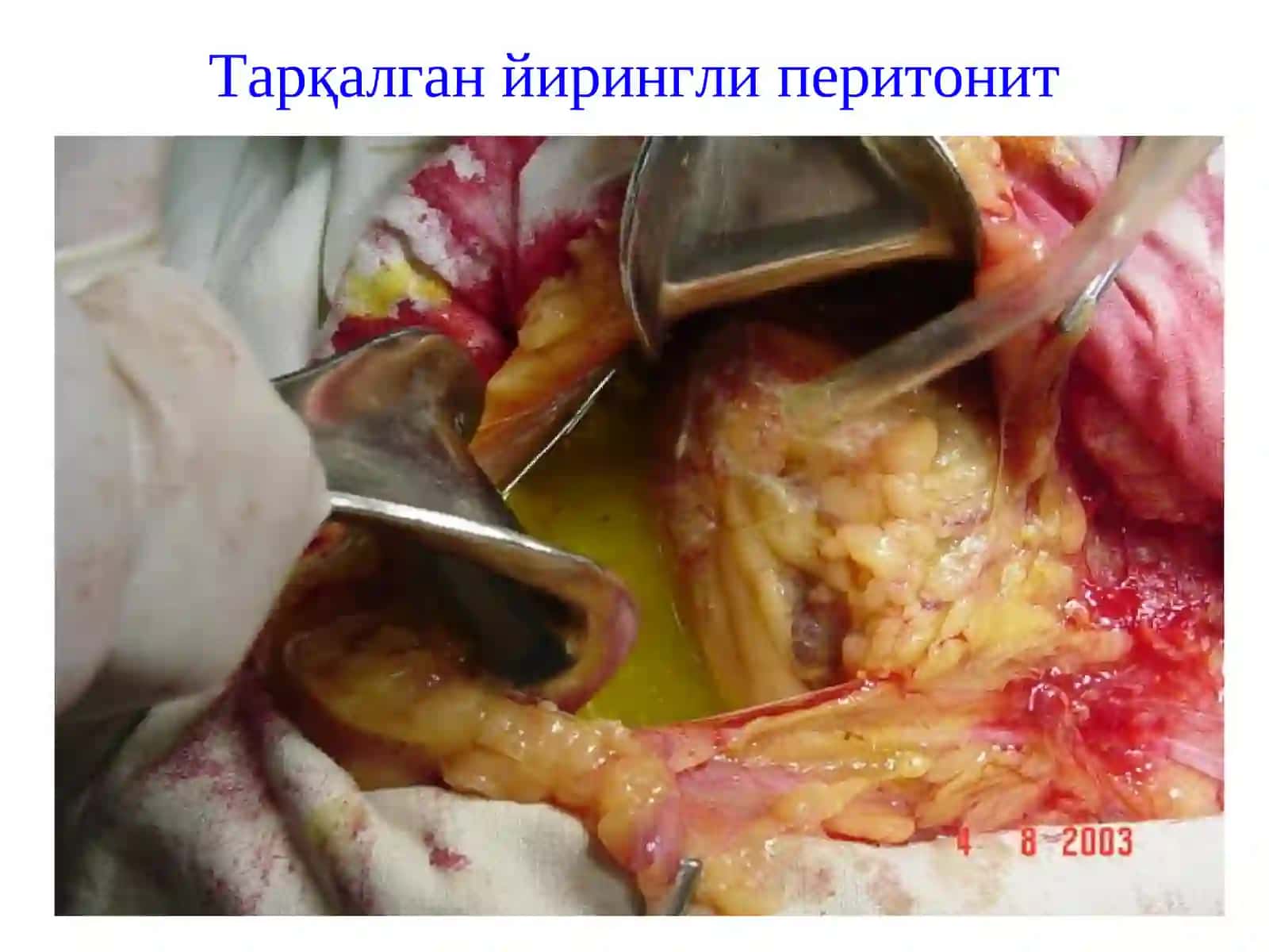 Перитонит-висцералвапариеталқор 4