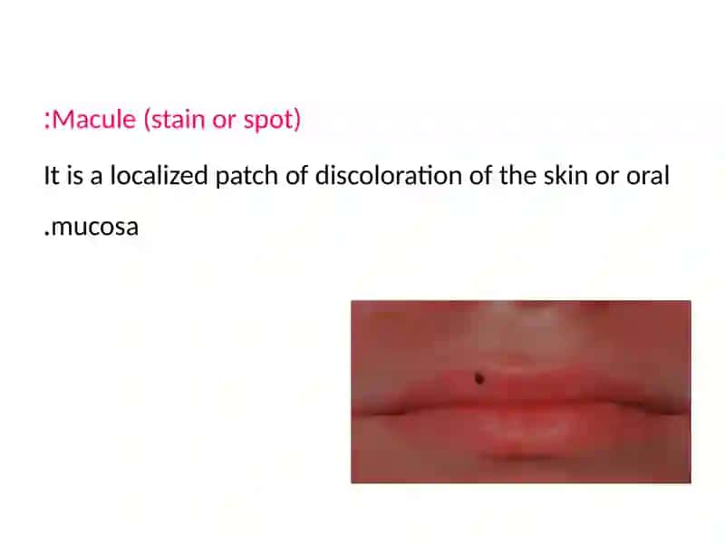 Oral infection 4