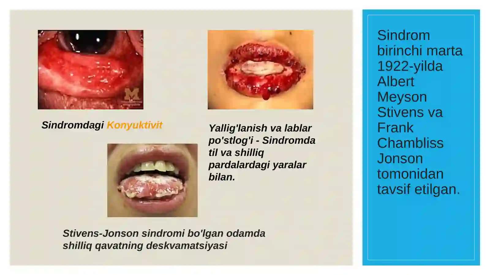 Stivens-djonson va layell sindromlari 4