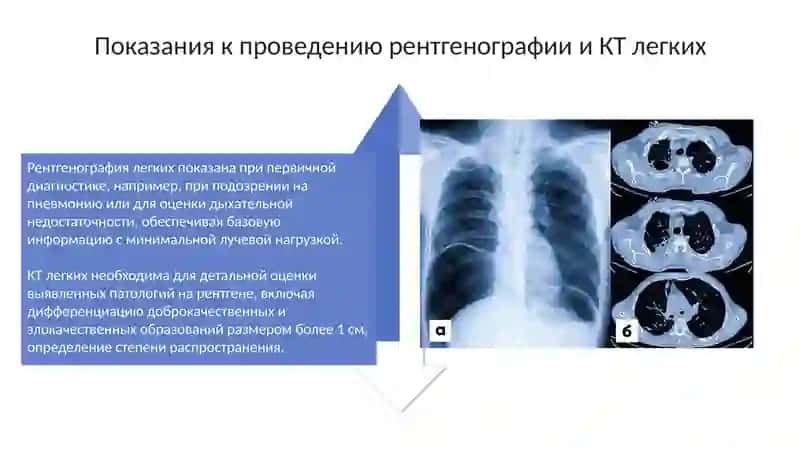 Презентация: Рентген и КТ легких 4