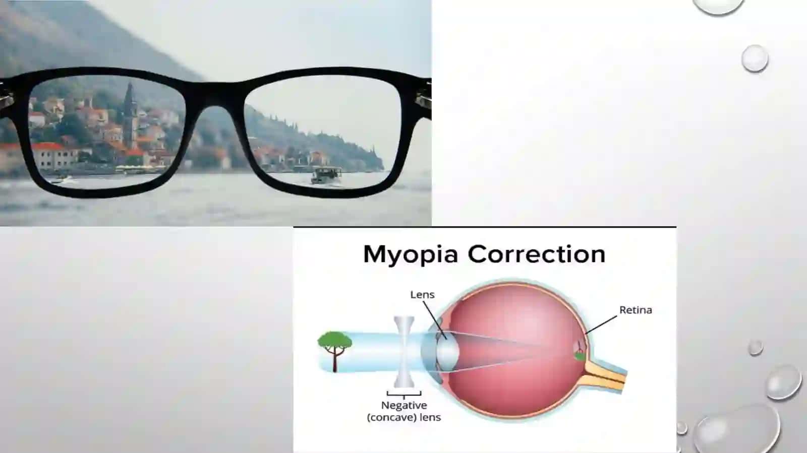 Ko’rishni optik korreksiyasi. Optik ko’zoynak turlari 4