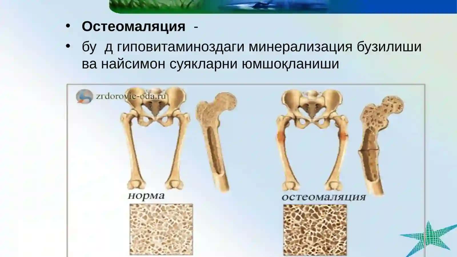 Bolalarda raxit va spazmofiliya kasalligi. 4