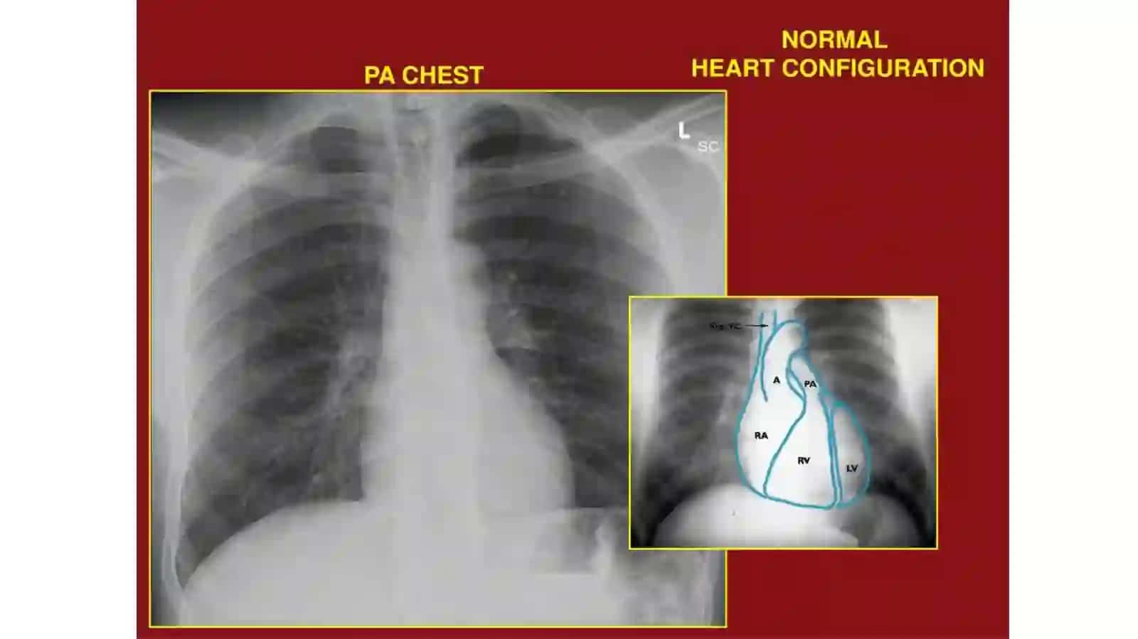 Yurakkonfiguratsiyasi (Heart Configuration) 4