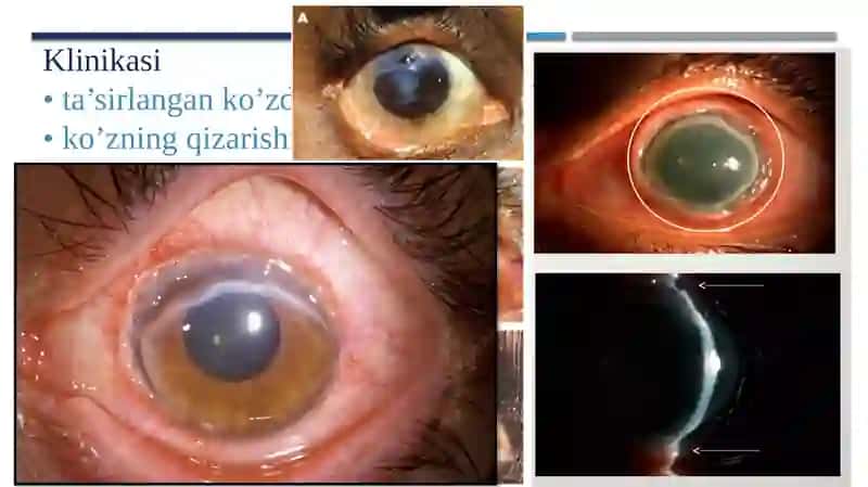 Noaniq etiologik likeratitlar 4