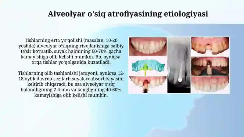 Alveolyar o'siq atrofiyasi 4