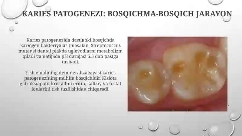 Kariesning etialogiyasi va potogenezi 4