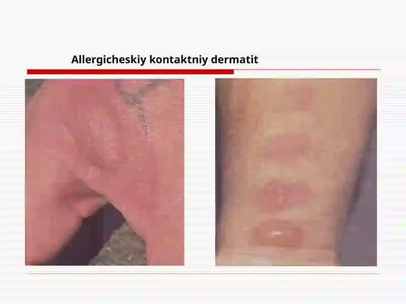 Teri kasalliklari 4