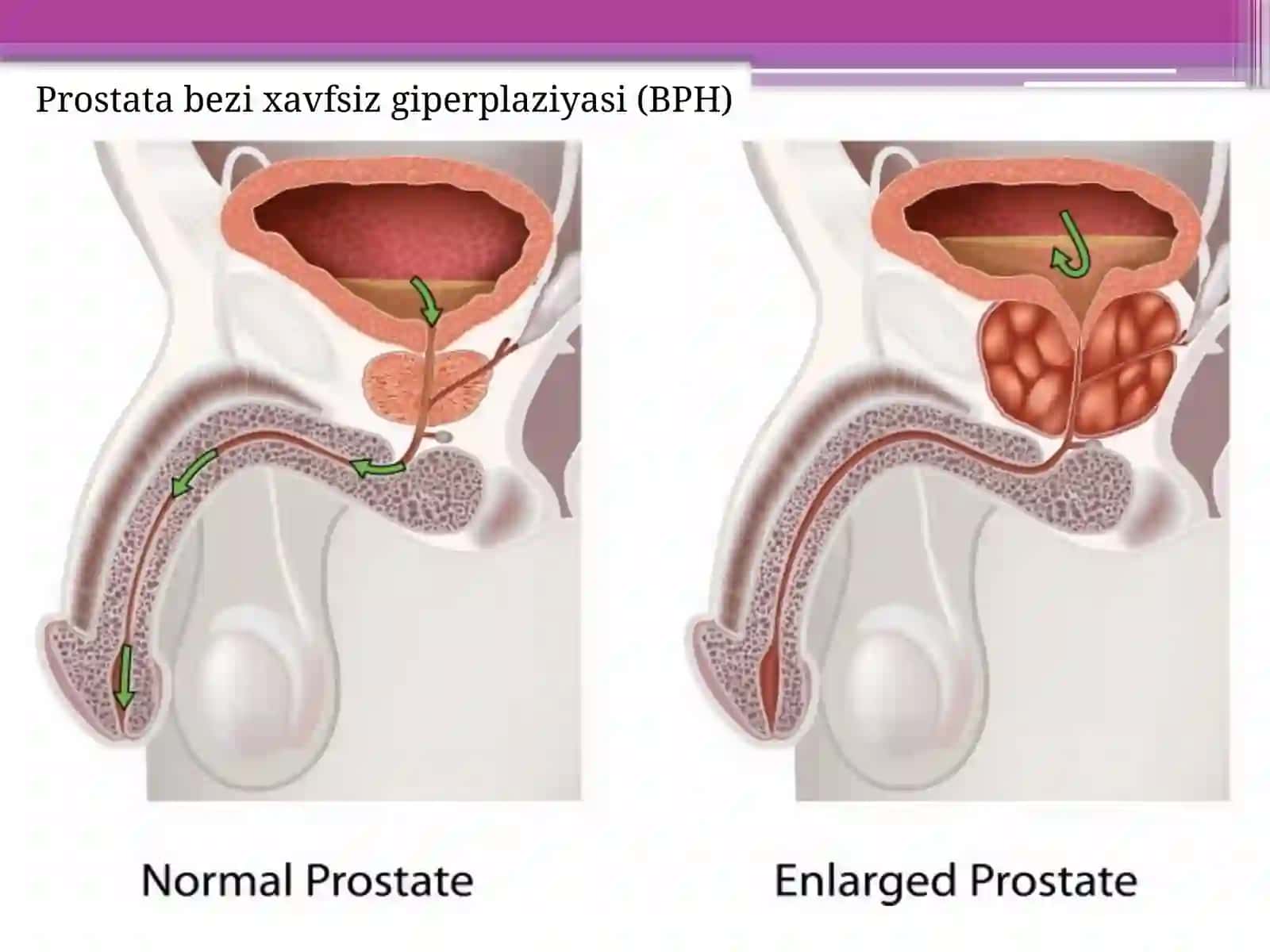 Prostata bezi o`smalari // urologiya 4