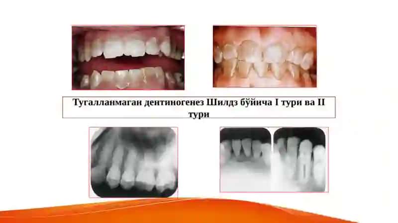 Тугалланмаган дентиногенез 4