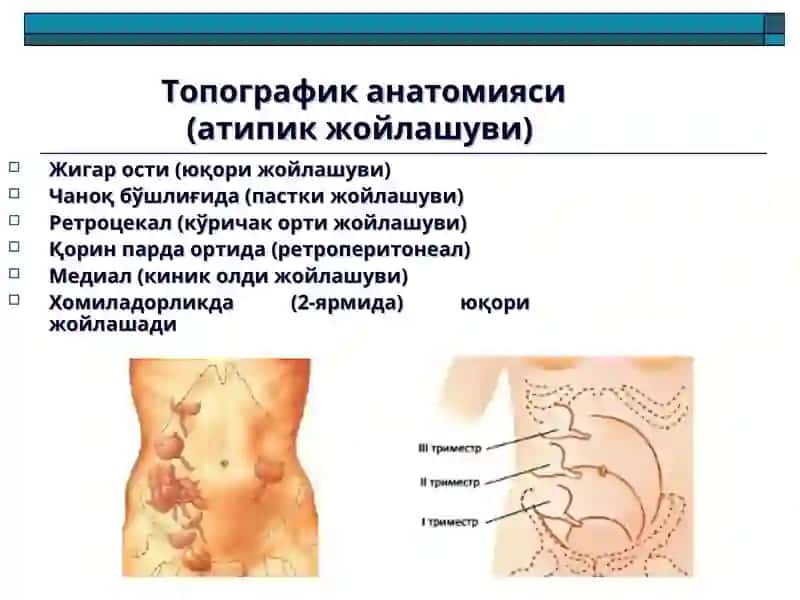 Ўткир аппендицит ва унинг асоратлари 4
