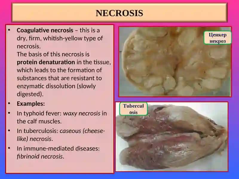 NECROSIS Lecture 4