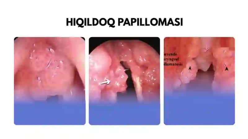 Hiqildoq papillomasi 4