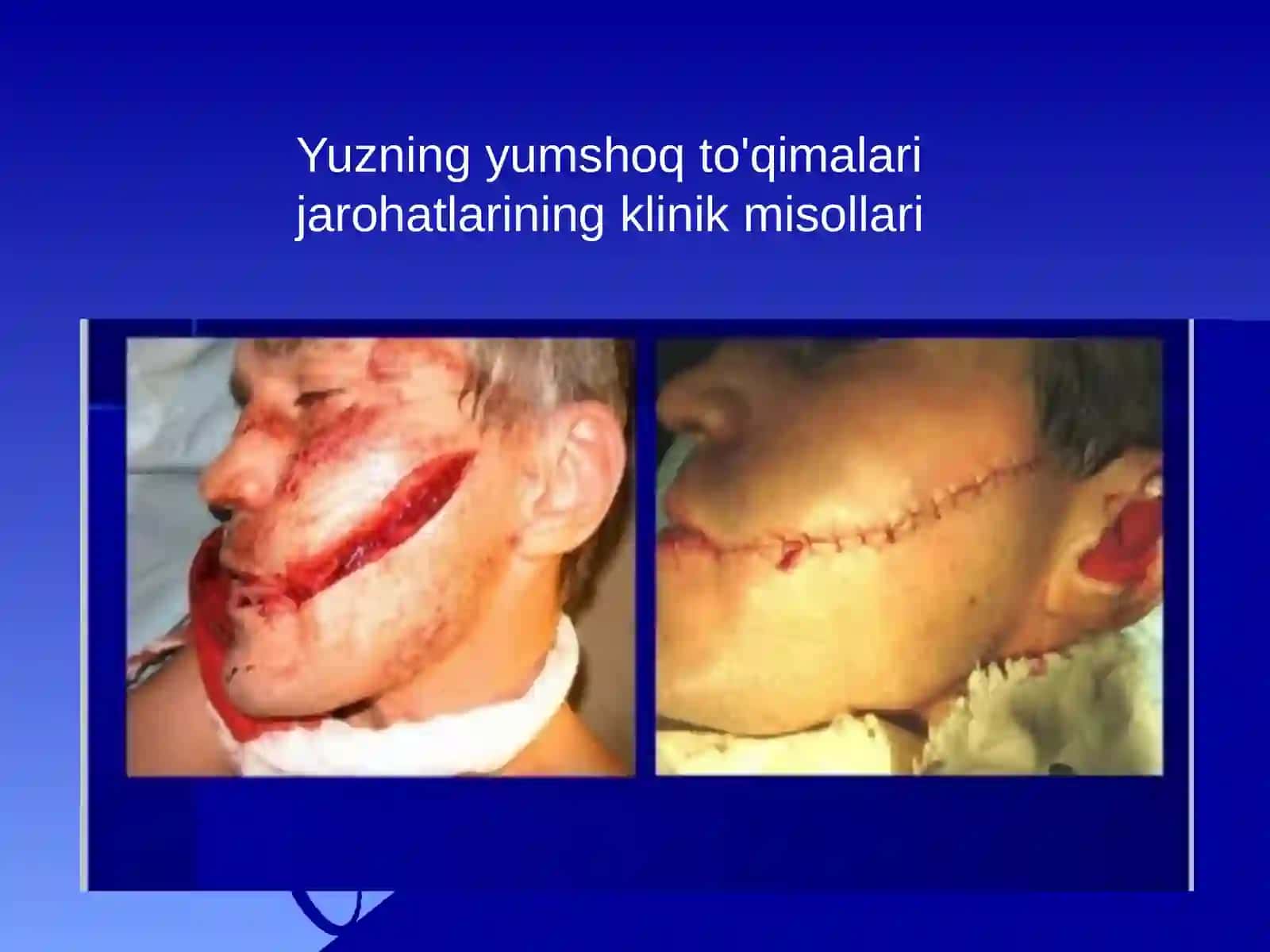 Yuzyumshoqto'qimalarijarohatlari 4