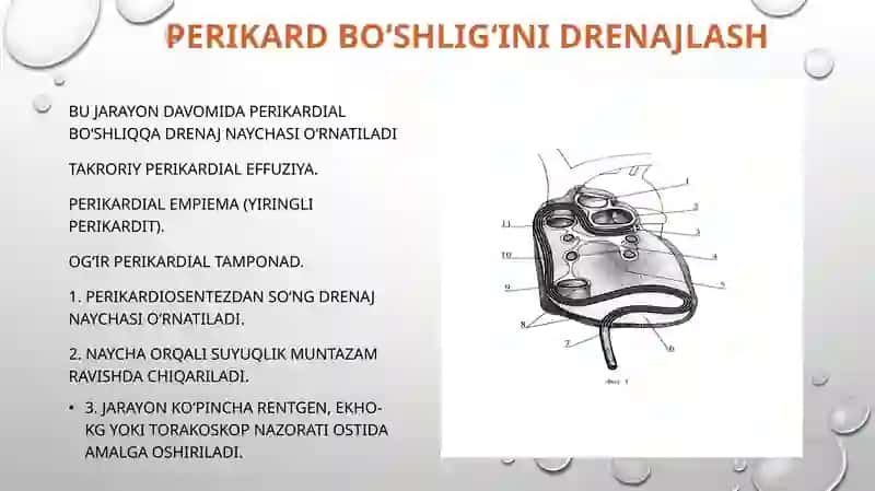 Perikarditlarda operatsiyalar 4