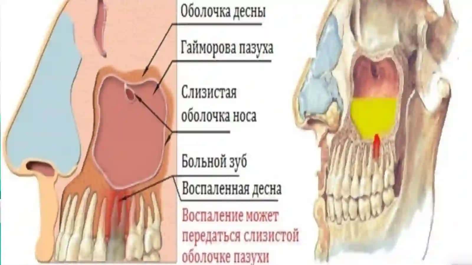 Odontogengaymorit 4
