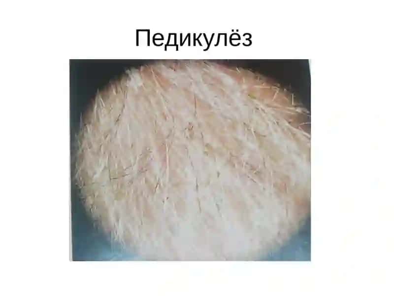 Битлаш (педикулёз) 4
