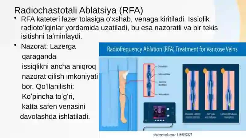 Oyoq venalari varikoz kasalligida bajariladigan operatsiyalar 4