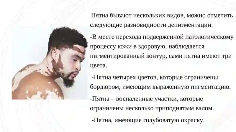 Витилиго 4