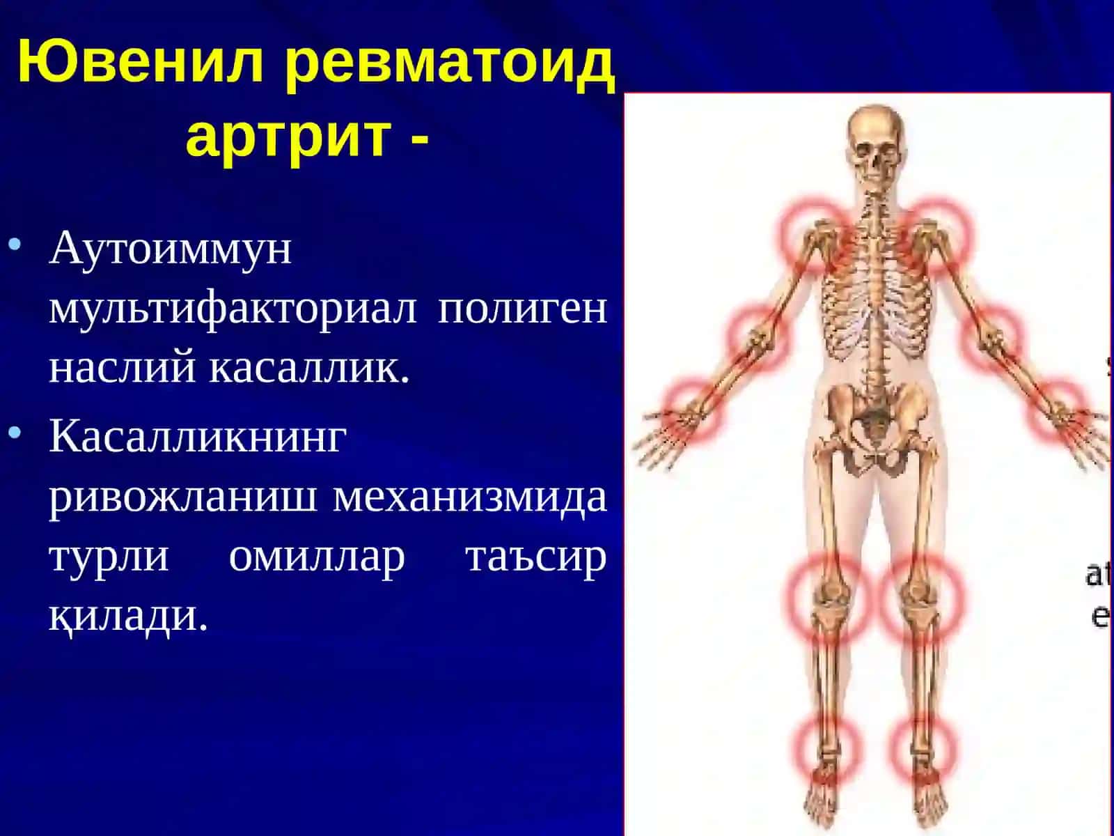 ЮВЕНИЛ РЕВМАТОИД АРТРИТJUVENILE RHEUMATOID ARTHRITIS 4