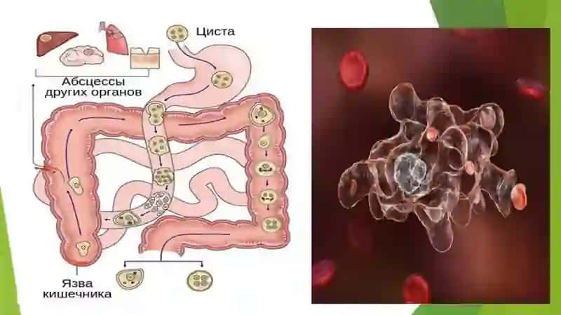 Amebiaz etiologiyasi, patogenezi va davolash 4
