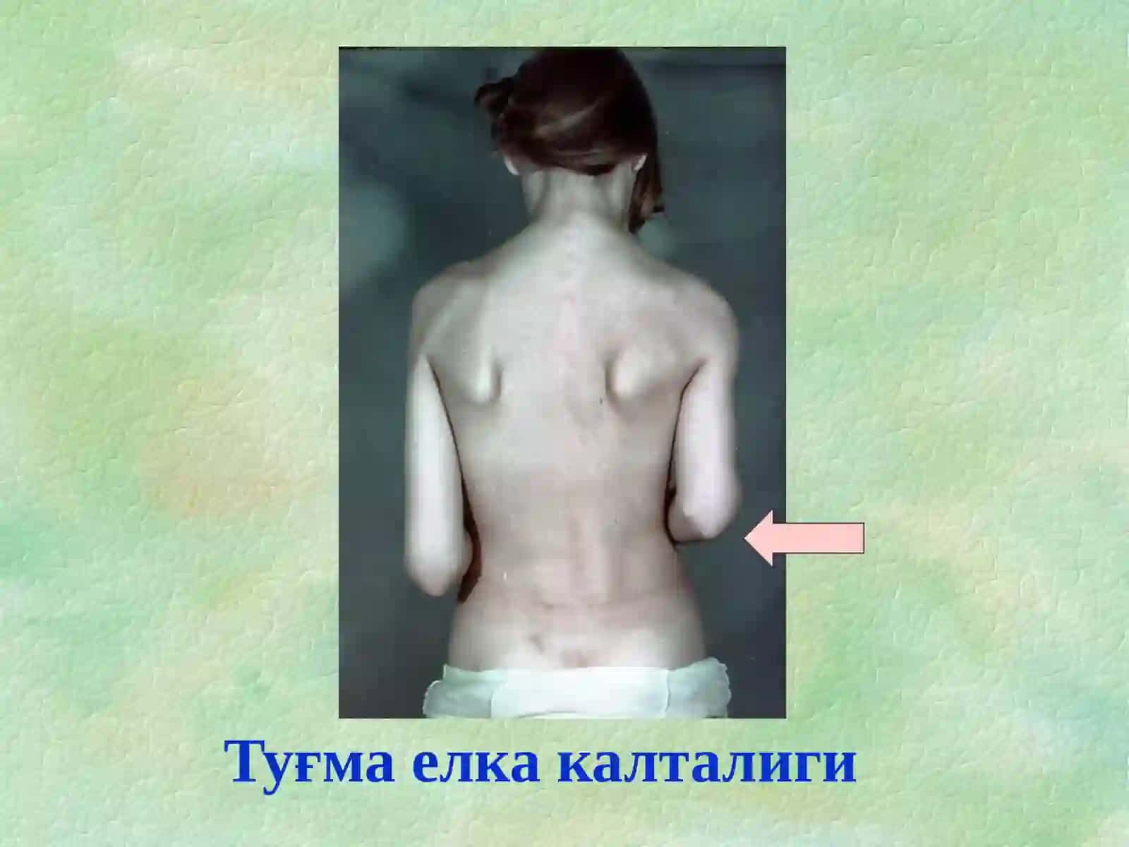 Туғма оёқ-қўл нуқсонлари 4