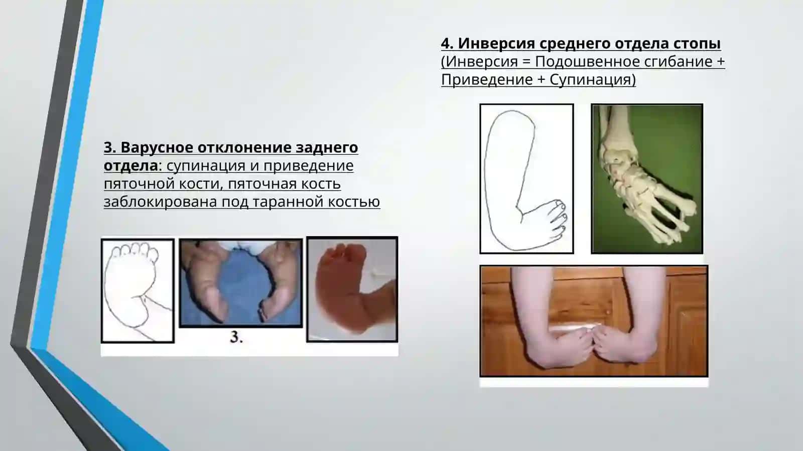 Врожденная косолапость у детей 4