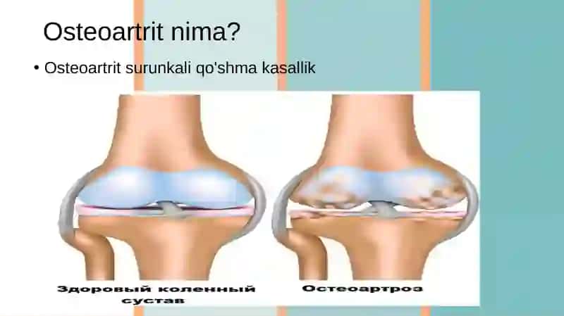 Osteoartrit 4