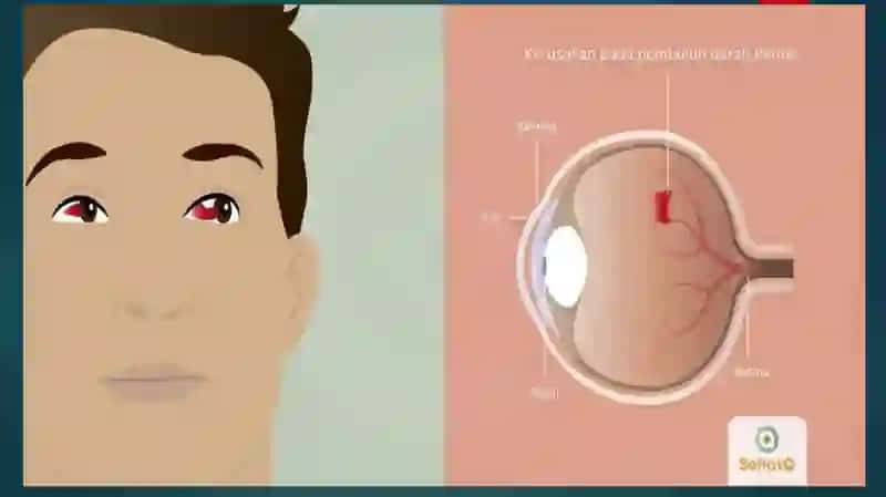 DIABETIK RETINOPATIYA 4