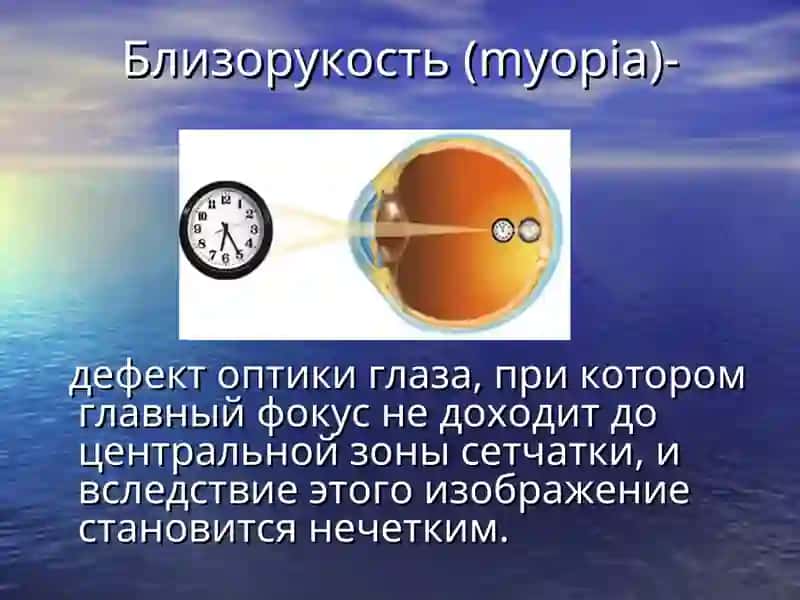Близорукостьи ее профилактика 4