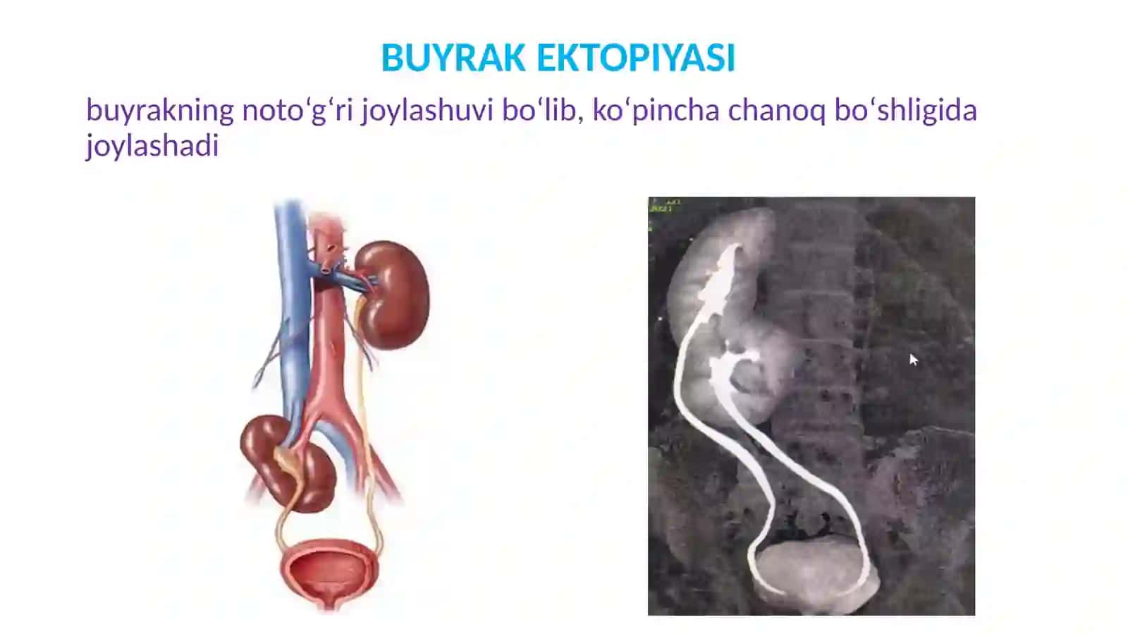 BUYRAK VA SIYDIK YO’LLARI KASALLIKLARI 4