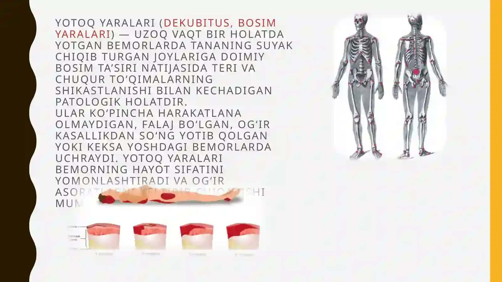 Yotoq yaralar va uning oldini olish choralari 4