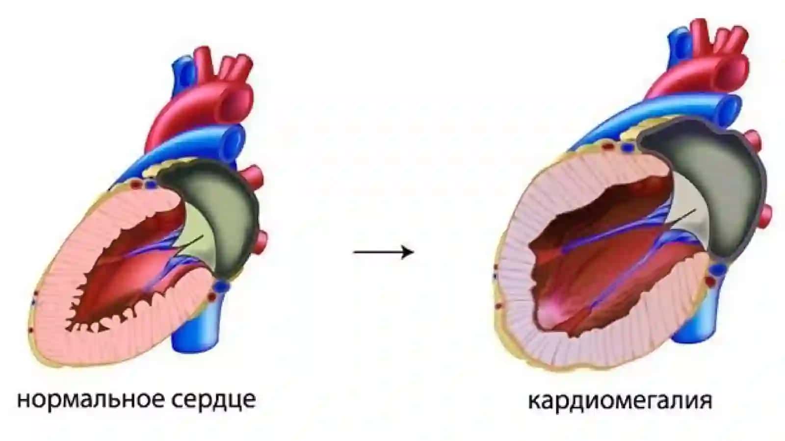 Kardiomegaliya 4