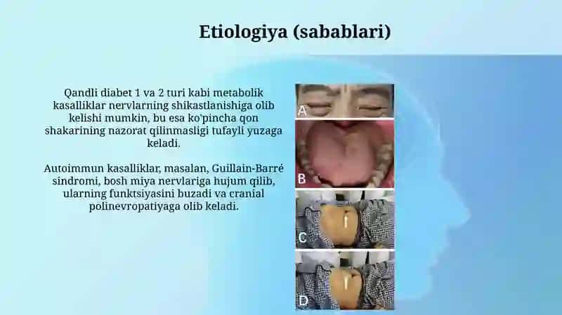Kraniyal poliyoneyropatiya 4