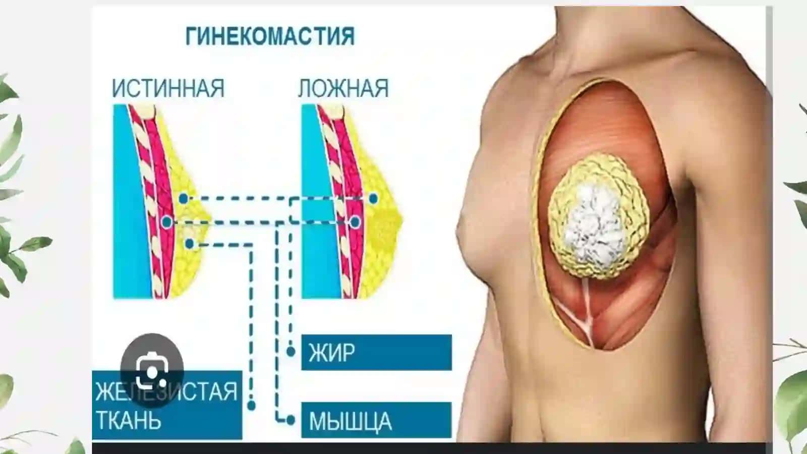 Ginekomastiya sindromi 4