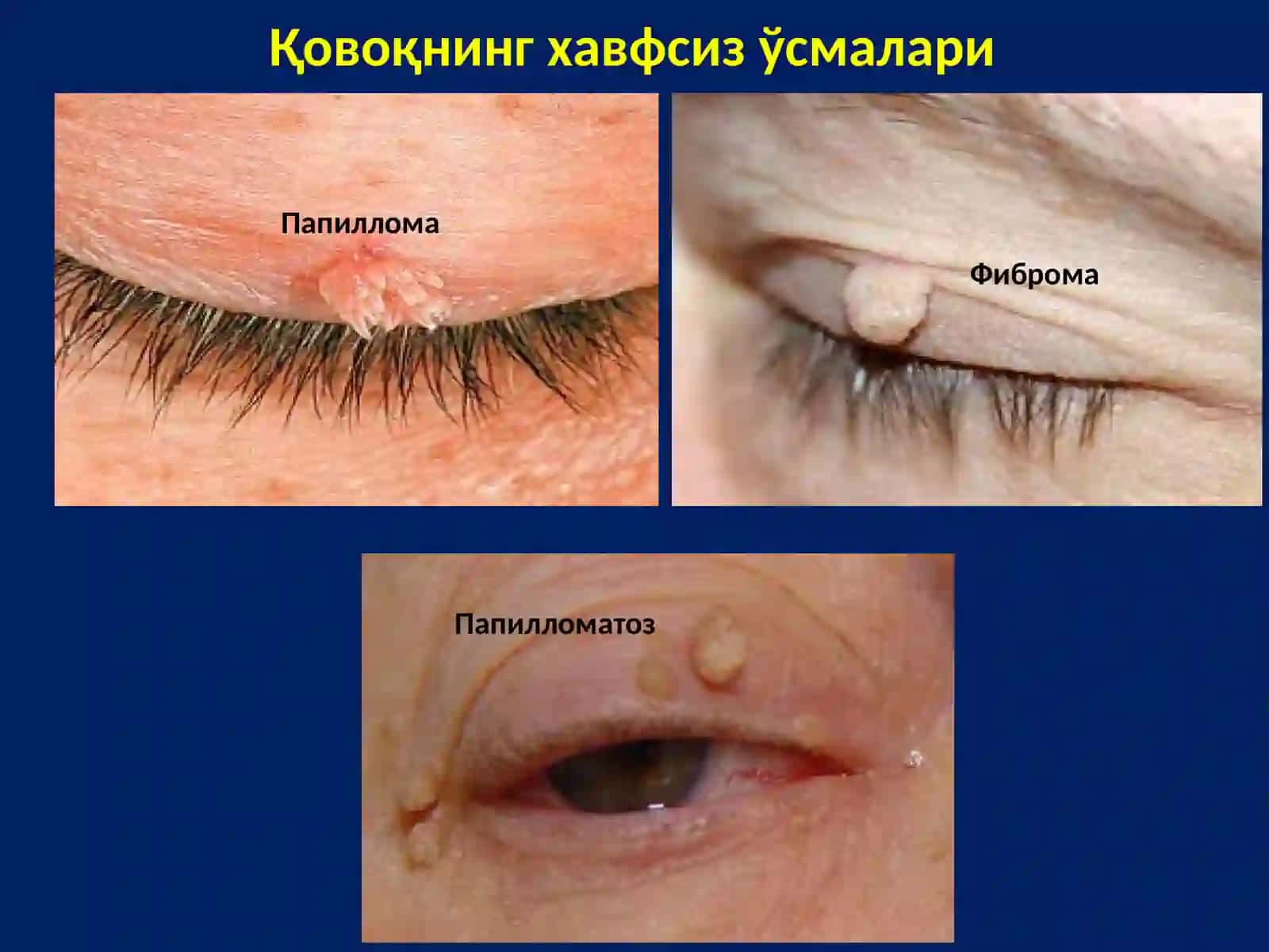 Кўрув аъзоси ўсмалари 4