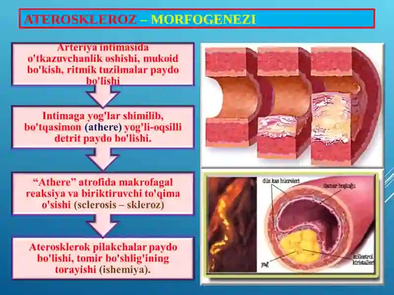 Ateroskleroz va Gipertoniya kasalligi 4