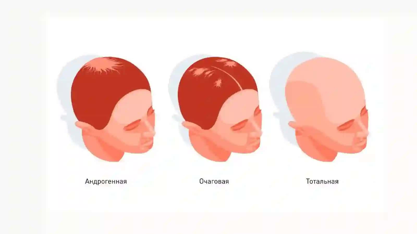 ALOPESIYANING ZAMONAVIY DAVOLASH USULLARI 4