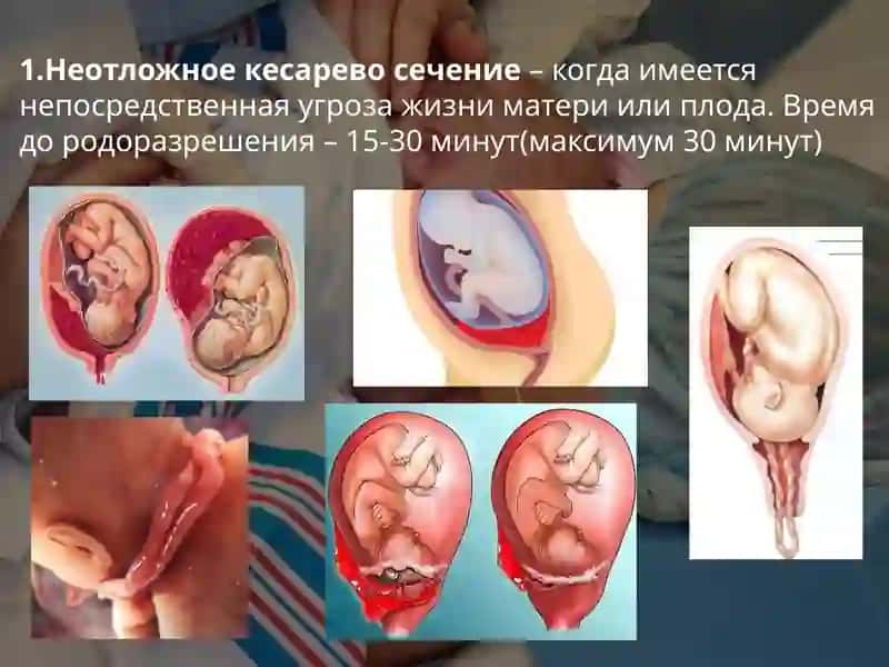 Кесарево сечение 4