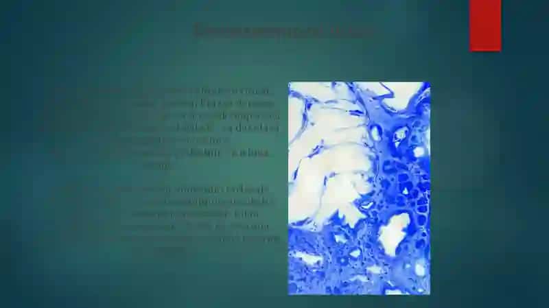 Dermatomiozit 4