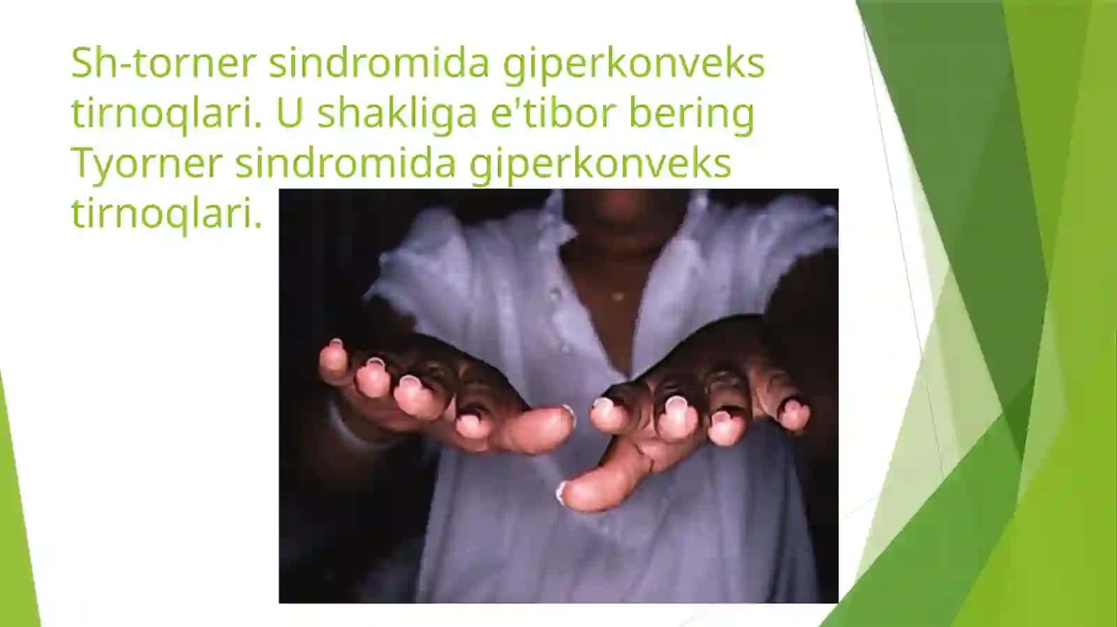 Sheresheviski-terner sindiromi 4