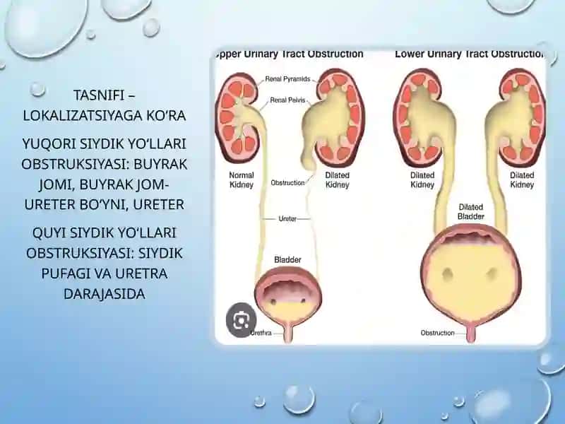 Siydik yo‘llari obstruksiyasi (SYO) 4