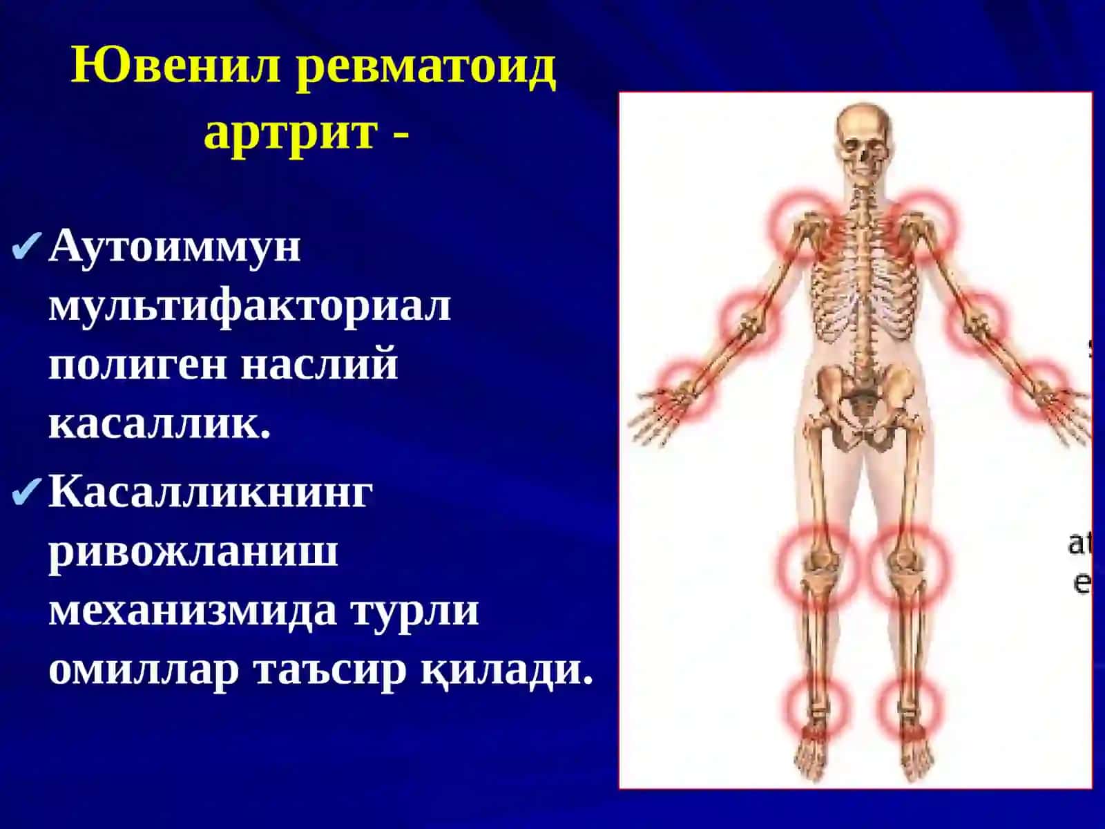 ЮВЕНИЛ РЕВМАТОИД АРТРИТJUVENILE RHEUMATOID ARTHRITIS 4