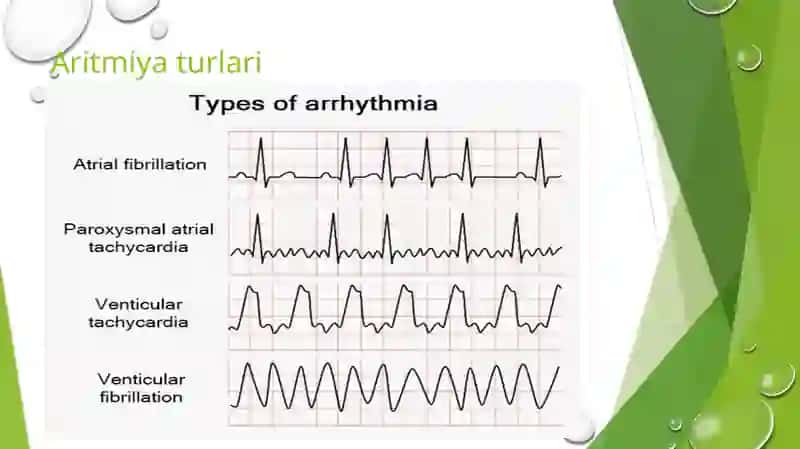 YurakaritmiyalariEKG diagnostikasi 4